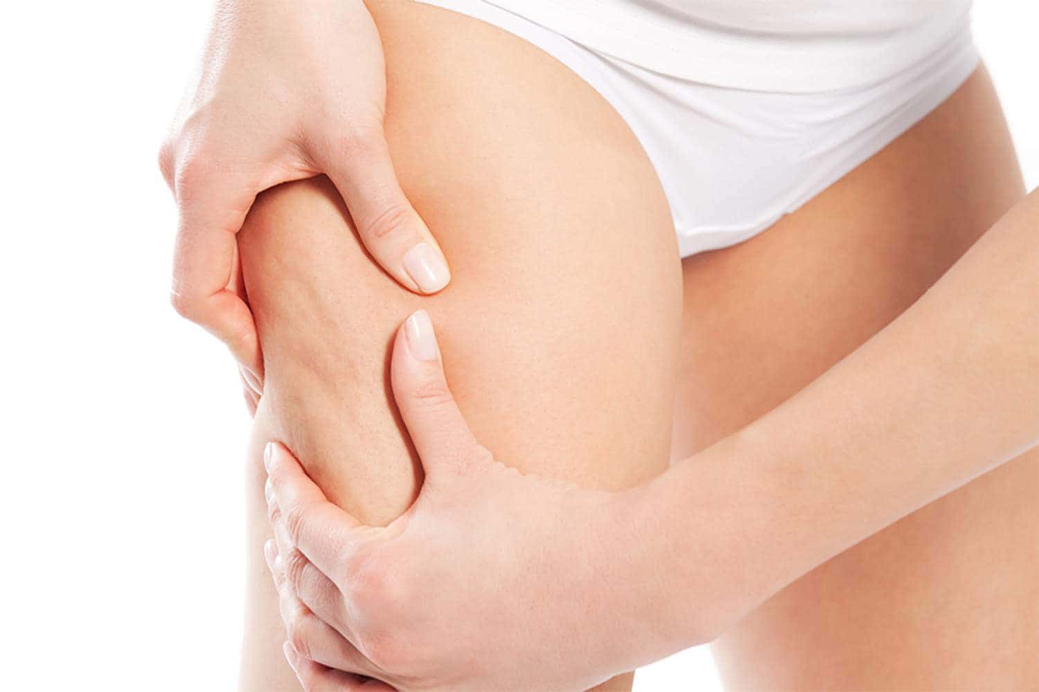 I Vari Tipi di Cellulite