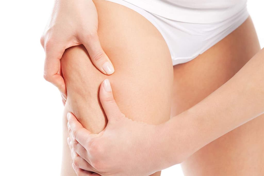 I Vari Tipi di Cellulite
